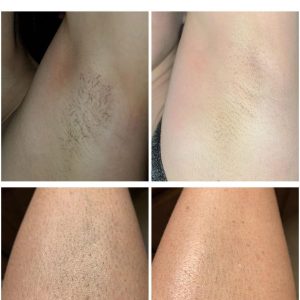 Crystalskin Laser Hair Removal