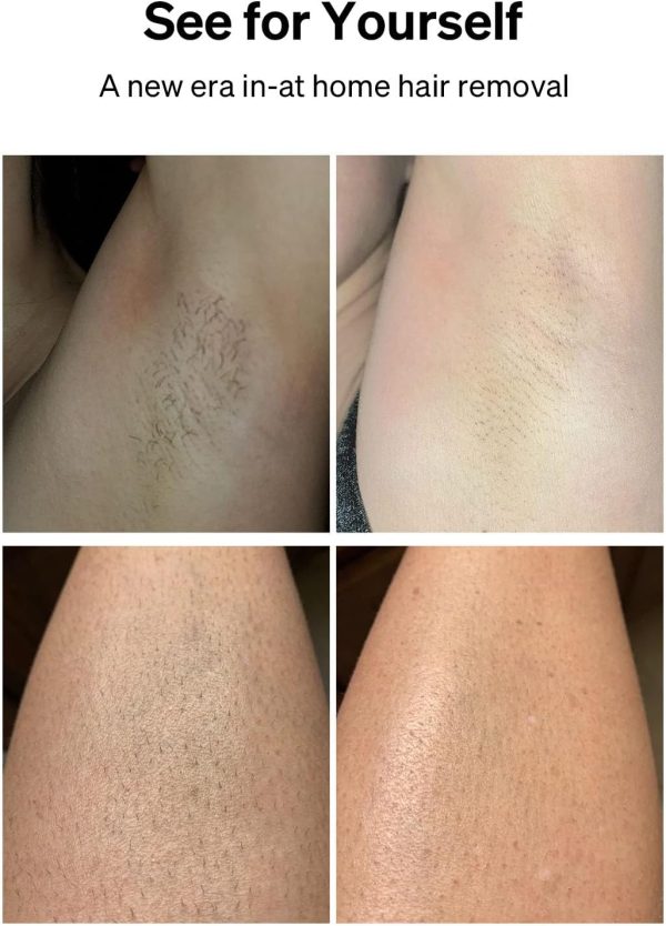 Crystalskin Laser Hair Removal