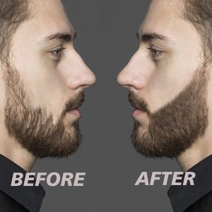 Beardfiller Set - Tighter And Fuller Beard For All Men!